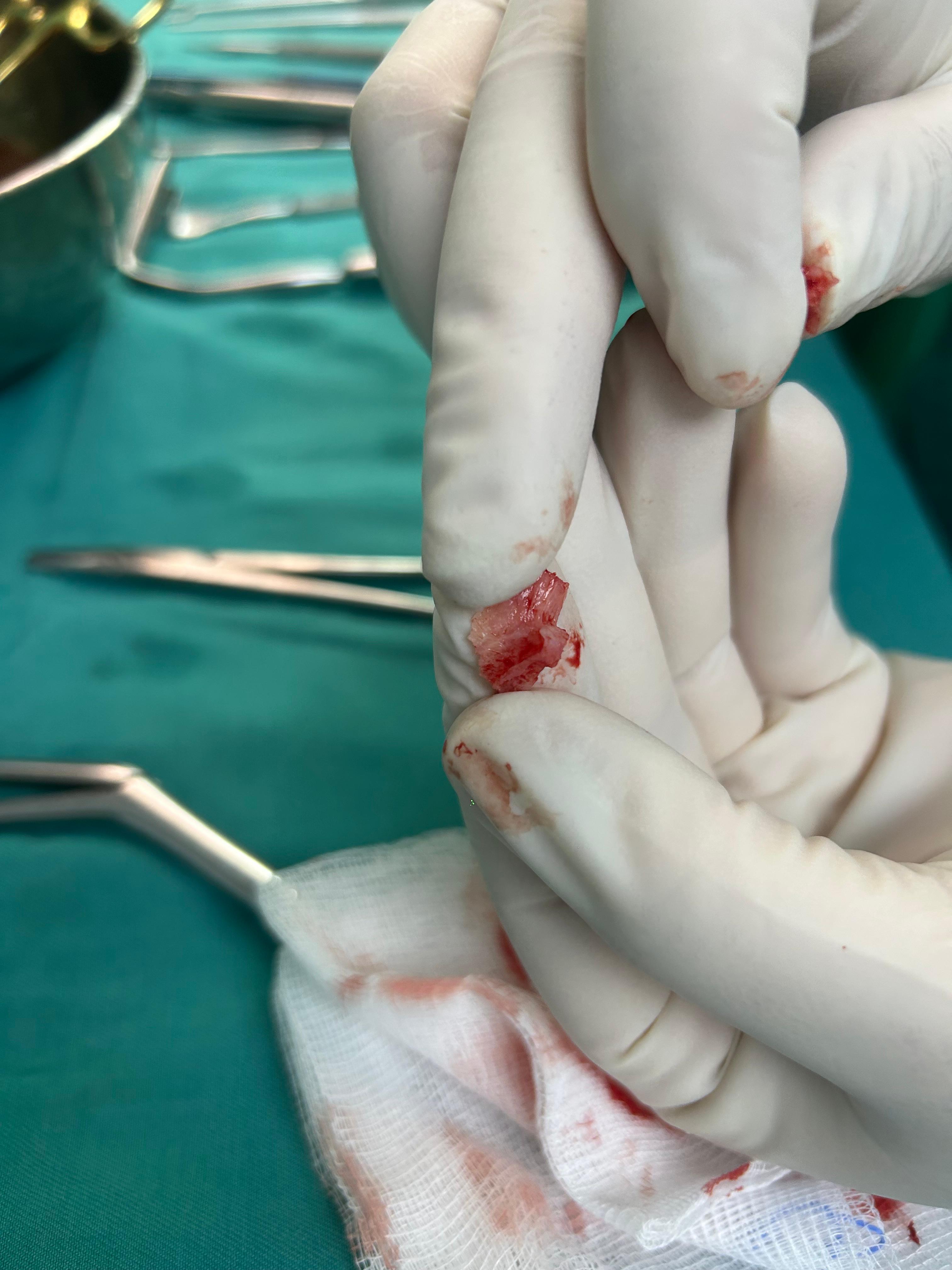Caso clínico: rinoplastia de revisión secundaria — corrección de asimetría y punta colapsada